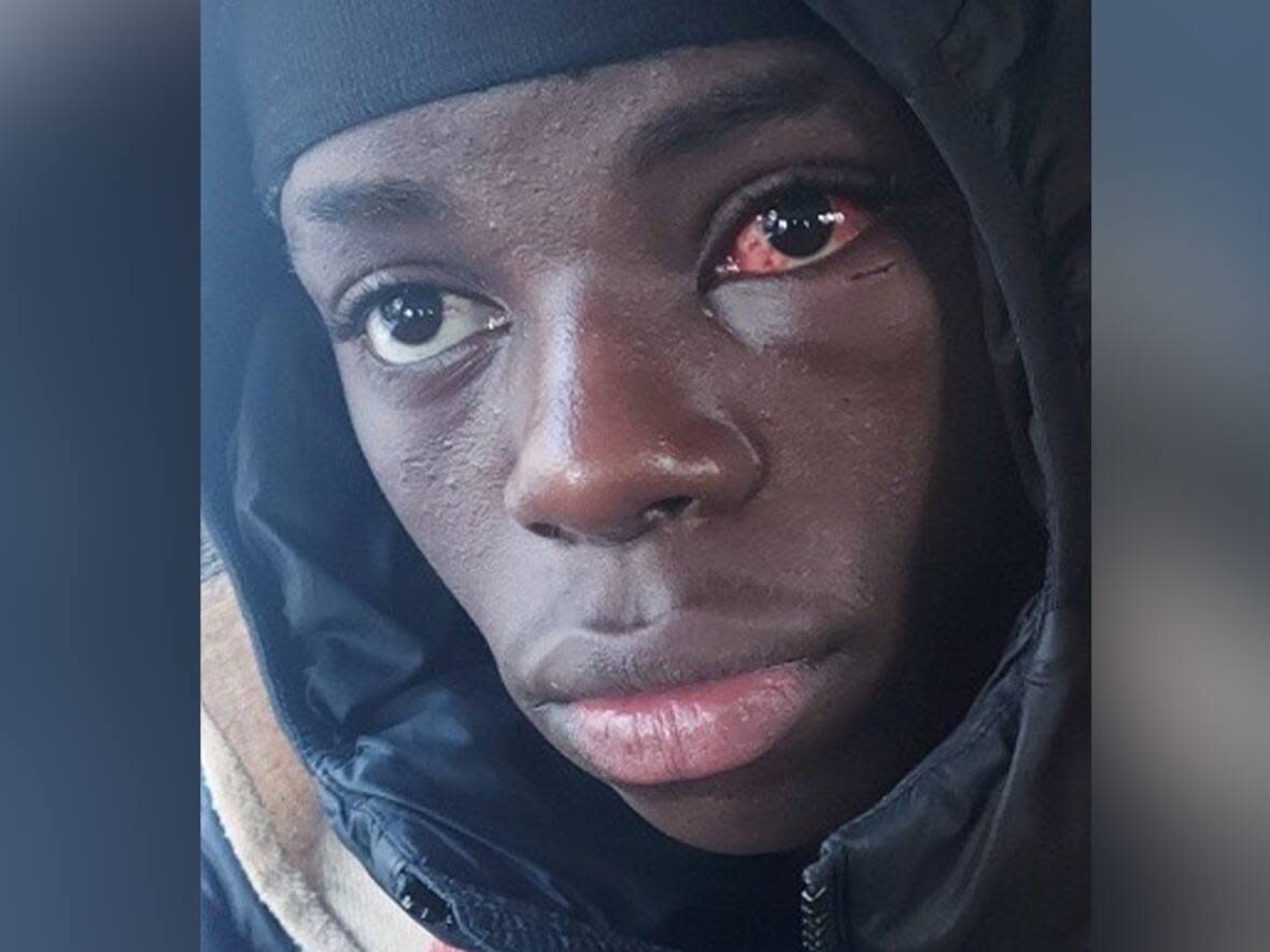 Police officers left Pacifique Niyokwizera, then 18, with a bloody eye during a police intervention in Quebec City last November.  (Submitted by Fernando Belton - image credit)