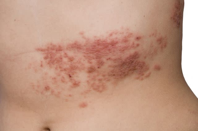 shingles on spine