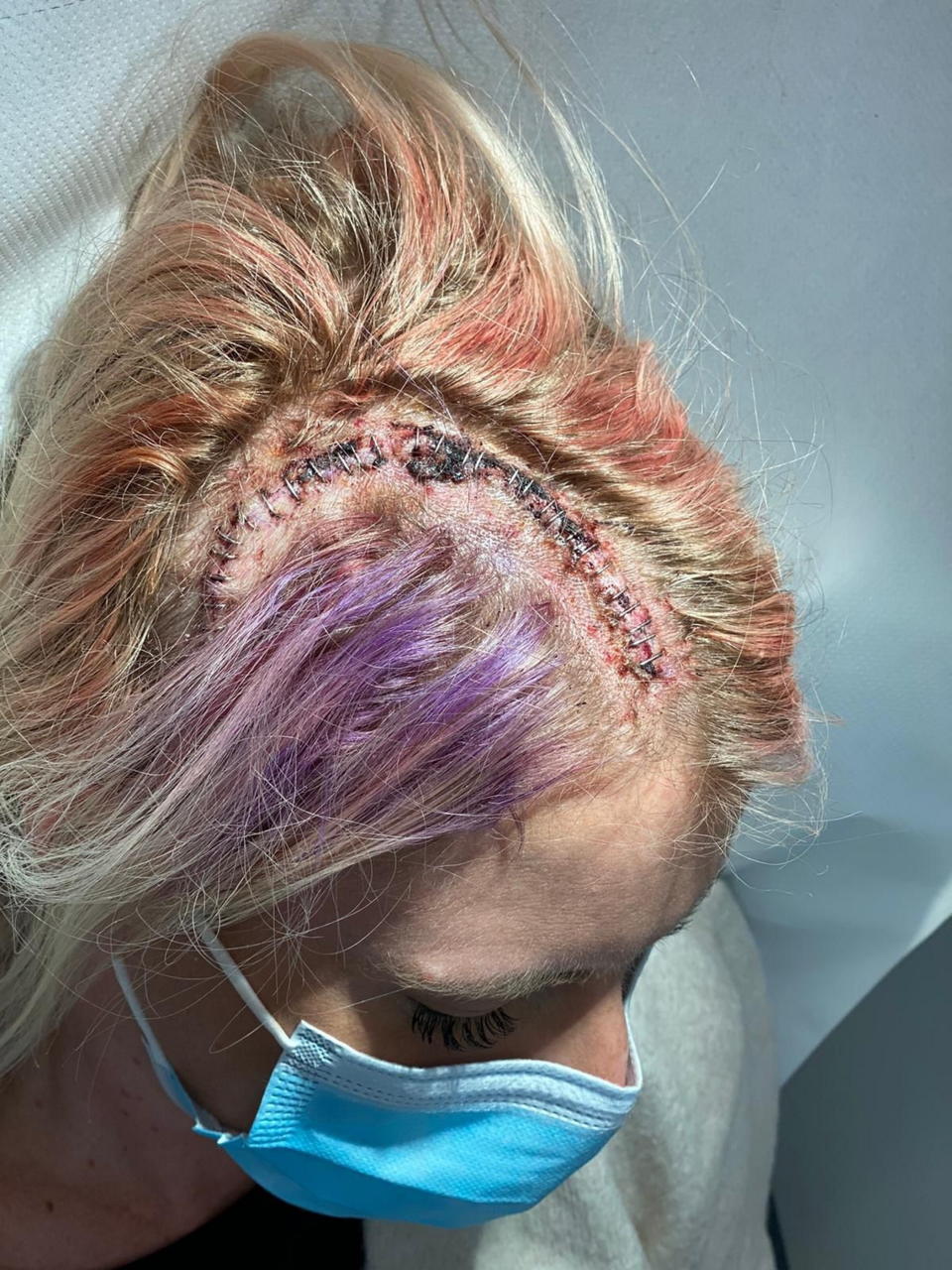 Connell in hospital following surgery to remove her brain tumour. (Brain Tumour Research/SWNS)