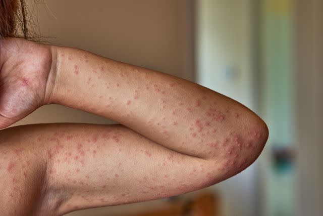 <p>JORGE CORCUERA / Getty Images</p> Allergic rash on the body of a 5 year old
