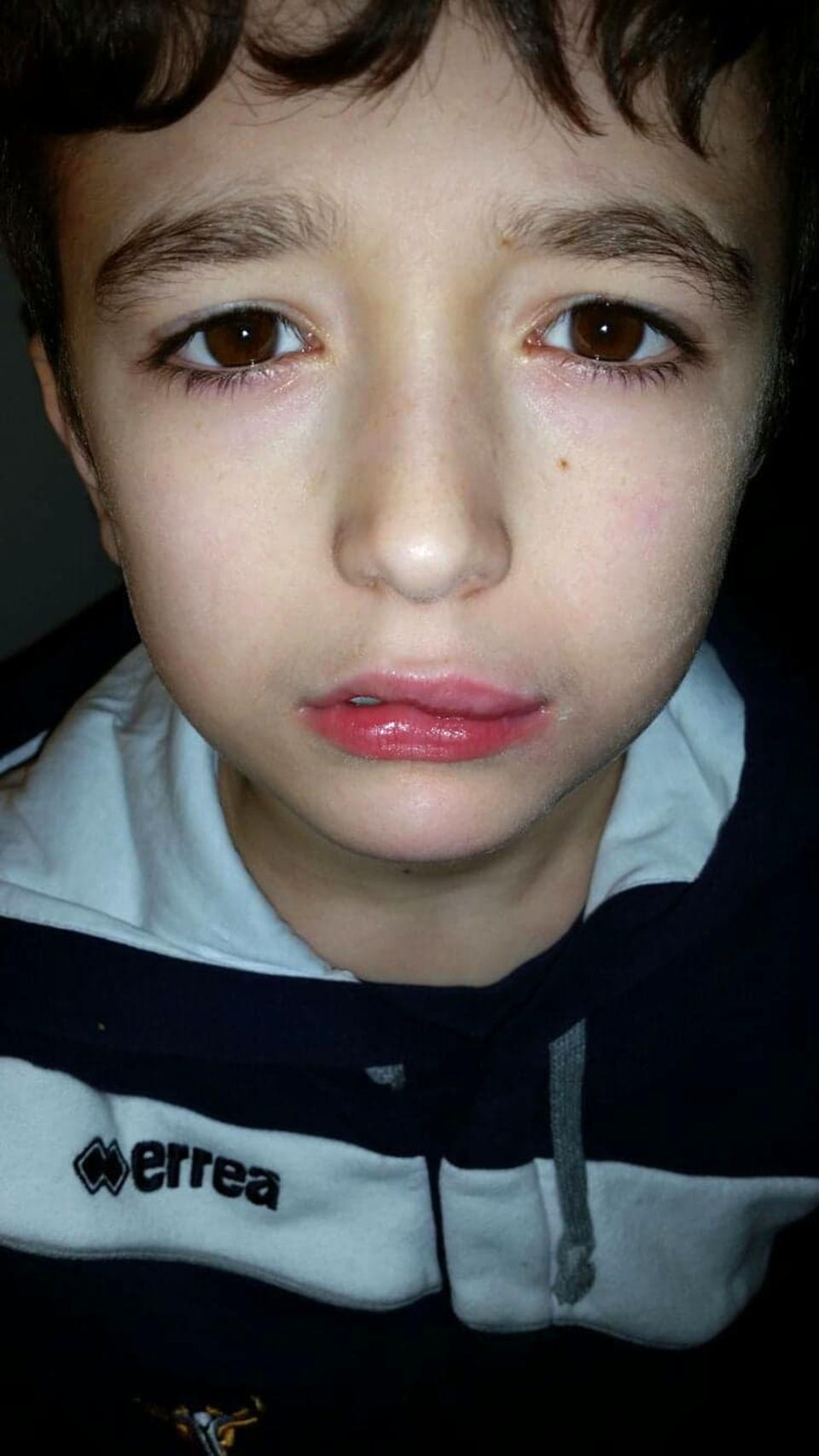 Aiden's lips swelled after an allergic reaction to Halloween sweets [Photo: Caters]