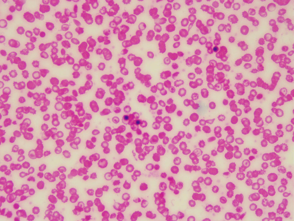 Image: Sickle cell anemia red blood cells under microscope (Ivan Mattioli / iStockphoto/ Getty Images)