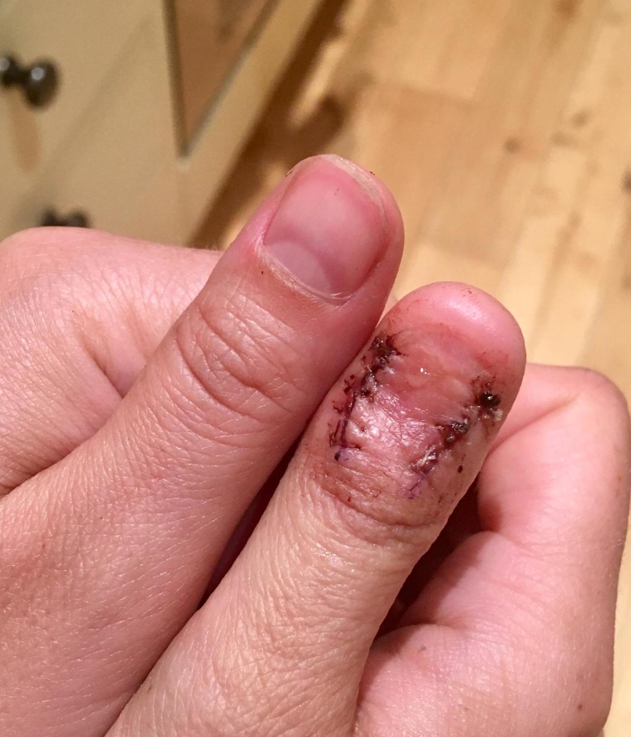 Alana Severs' thumb is now healing. (SWNS)