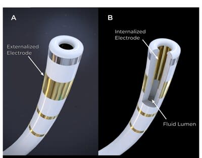 Field Medical’s FieldForce™ Catheter tip (A). The FieldBending™ technology utilizes an innovative internalized electrode within a fluid lumen seen in the cutaway (B). Voltage is delivered between the external and internal electrodes resulting in desirable electric field characteristics. The FieldForce™ Catheter is the first and only contact force PFA catheter optimized for the ventricles. 