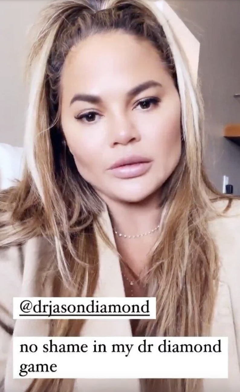 Chrissy Teigen Underwent Buccal Fat Removal But What Is It 2809