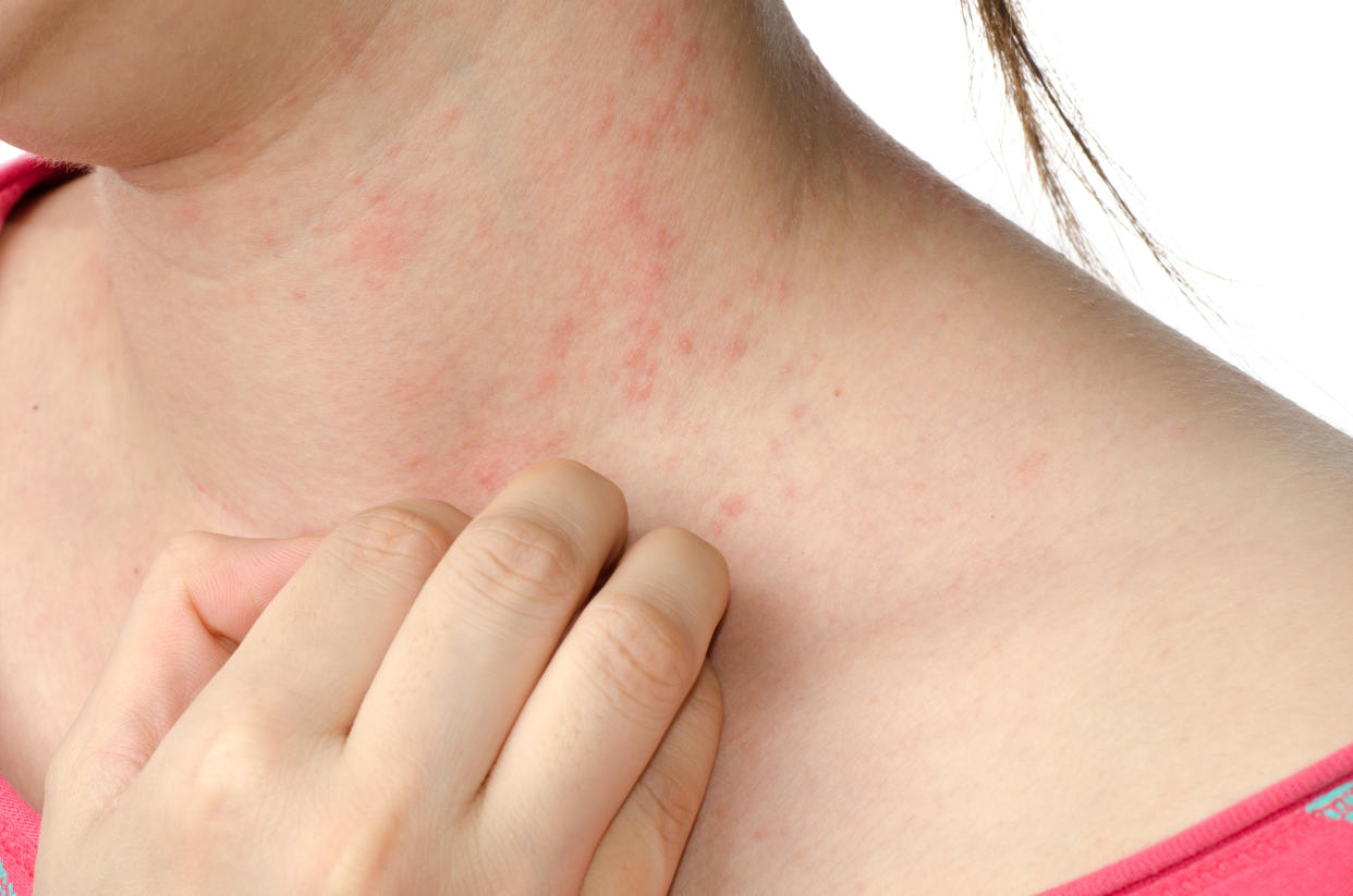 Skin condition contact dermatitis causes and contact dermatitis treatments (-aniaostudio- / Getty Images)