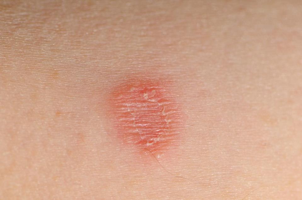 tinea corporis infection ring worm