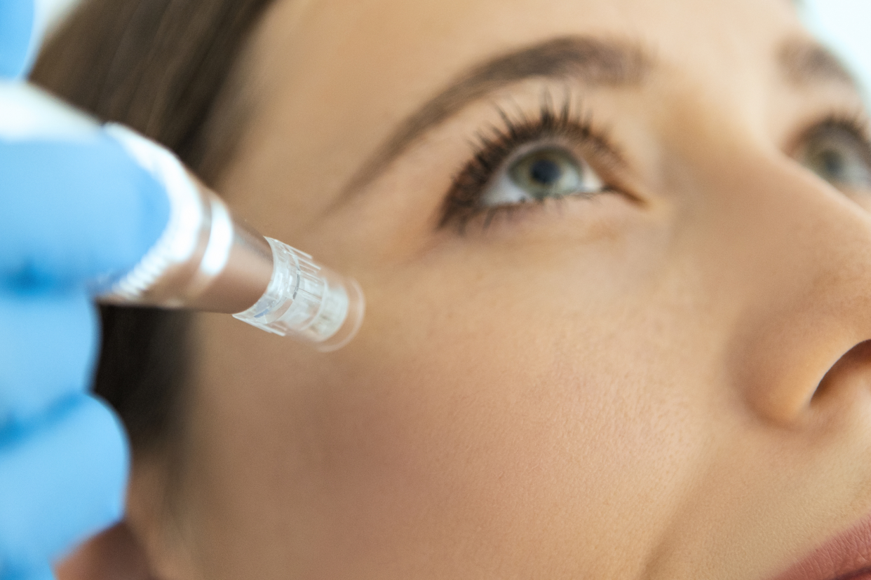 Closeup of Dermatologist Microneedling a Woman's Face