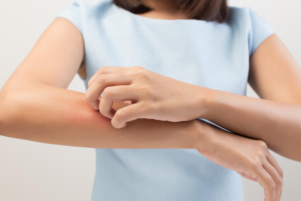 A woman itches eczema