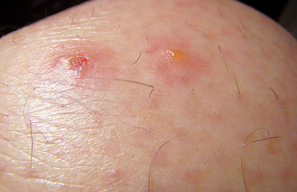 Chigger (coloradillo) wounds. (via Wikimedia Commons)