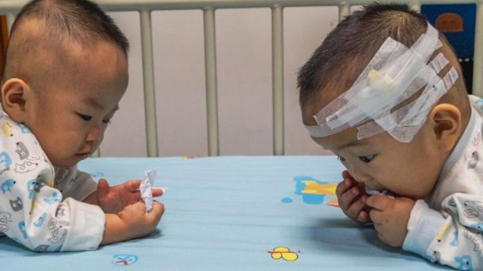 廣東一對雙胞胎罹患了罕見疾病，但父母親僅湊足1人的醫藥費。(圖／翻攝自陸網)