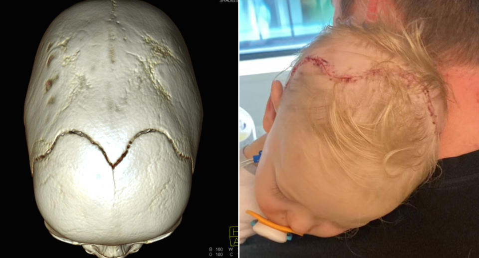 Xray showing baby's skull with stitches and scar.Source: JamPress/Australscope.