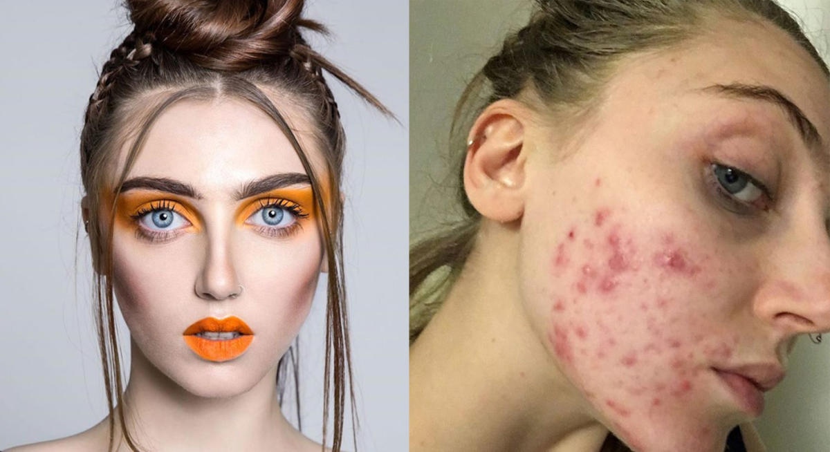 megan fox acne scars