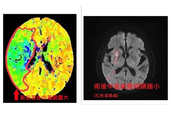 術前術後比較圖。（圖片／中國醫藥大學新竹附設醫院提供）