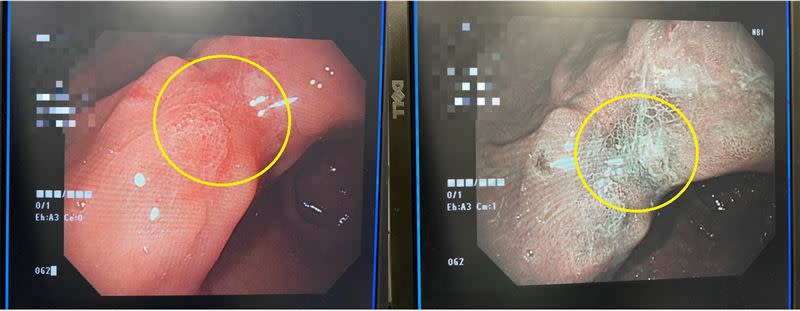 病患胃鏡檢查照，圖左為傳統影像、圖右為NBI窄頻光波影像，可明顯發現不太正常的細胞表現，二週後切片報告證實是胃腺癌。（圖／長安醫院提供）