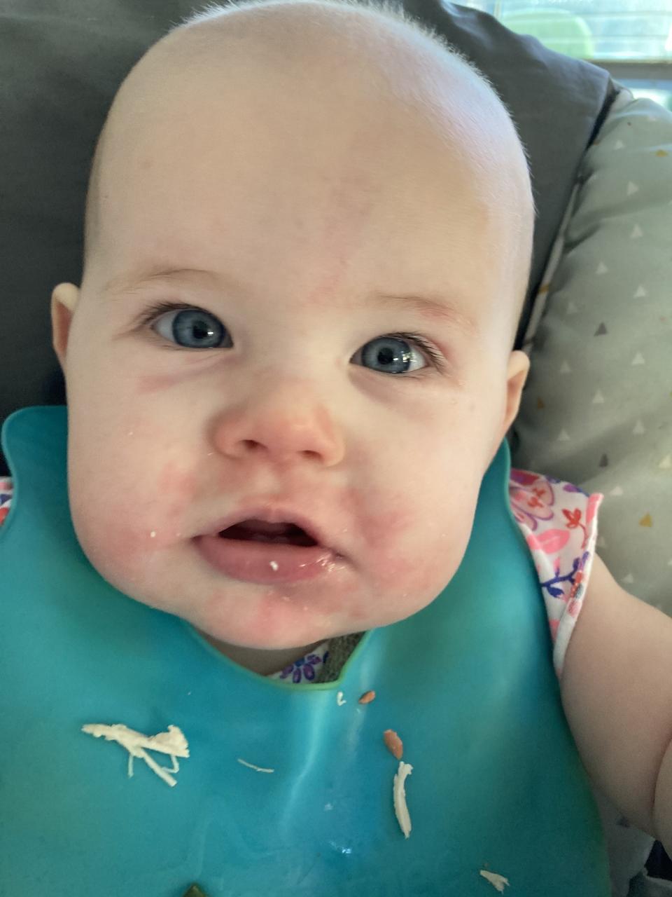 Image of a baby with a splotchy red rash beghinning around the mouth and stretching up to the eyes