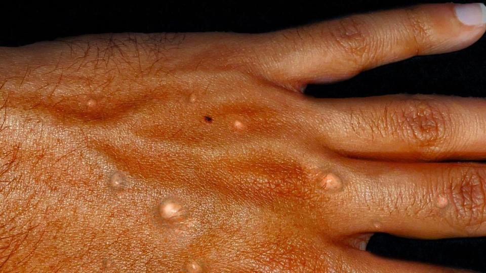 Mpox is spread through contact with bodily fluids.