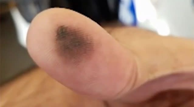 Abdl Ghaith's burnt thumb. Source: ABC7