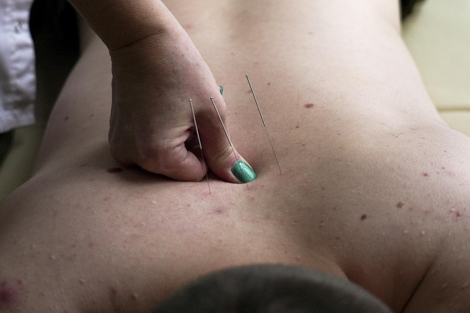 A doctor performs acupuncture on the back of a soldier at a clinic which treats veterans for PTSD, post-combat stress and post-concussion trauma, in Kyiv, Ukraine, Monday, Nov. 21, 2022. When peace returns to Ukraine, many thousands of its combatants will likely return with psychological scars from the battlefields. A mental health rehabilitation center for soldiers on the outskirts of Ukraine's capital, Kyiv, treats post-traumatic disorders with acupuncture, soothing sounds and other therapies. (AP Photo/John Leicester)