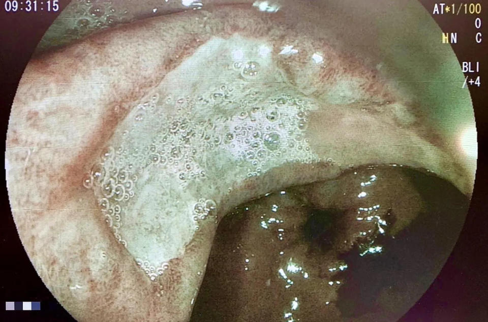 <strong>患者做胃鏡檢查，在「胃竇部」發現一扁平不規則潰瘍，經化驗，證實為胃黏膜組織淋巴瘤並合併幽門桿菌感染。（圖／蔡宗憲臉書）</strong>