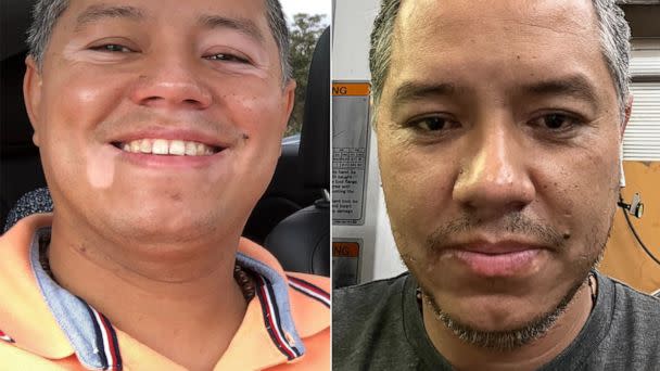 PHOTO: Berardo Rivas before and after using the first topical JAK inhibitor cream for the treatment of vitiligo. (Courtesy Berardo Rivas)