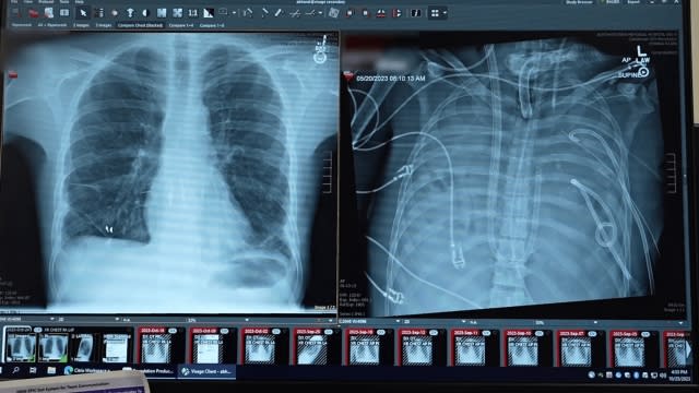 Side-by-side x-rays of the man's old lungs (right) and his new lungs.