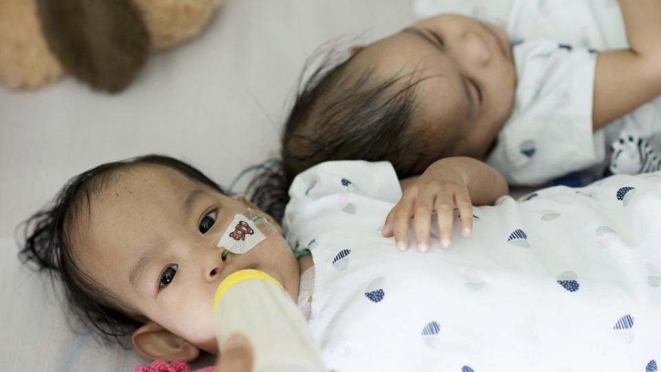 Sie dürfen zusammenbleiben: Nach ihrer Trennung schlafen die Zwillinge nicht gern in getrennten Bettchen. Foto: The Royal Children's Hospital Melbourne Creative Studio/AP