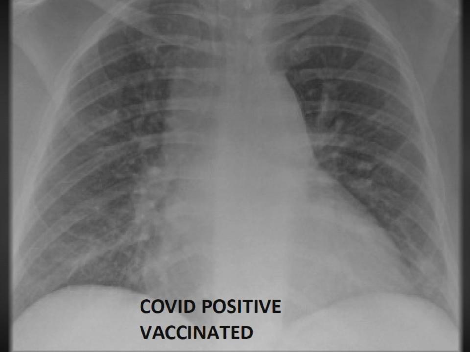 The x-ray image of the vaccinated individual infected with Covid-19 is a rare breakthrough case – less than one per cent of vaccinated people have been infected. (KSDK)
