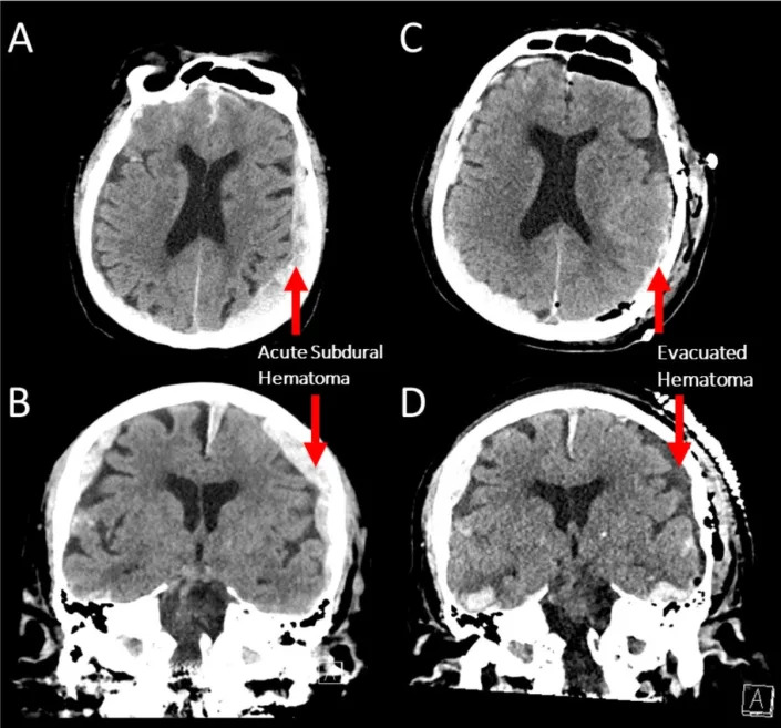 A scan of the brain of the Vancouver patient who, while being monitored for seizures, went into cardiac arrest and died.
