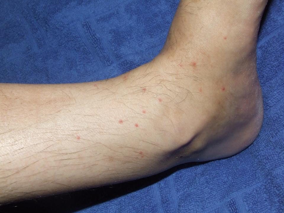 Flea Bites