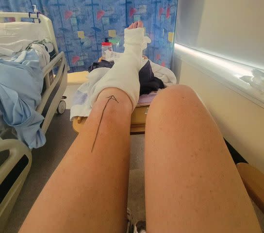 <p>katie archibald/instagram</p> Katie Archibald's leg in a cast