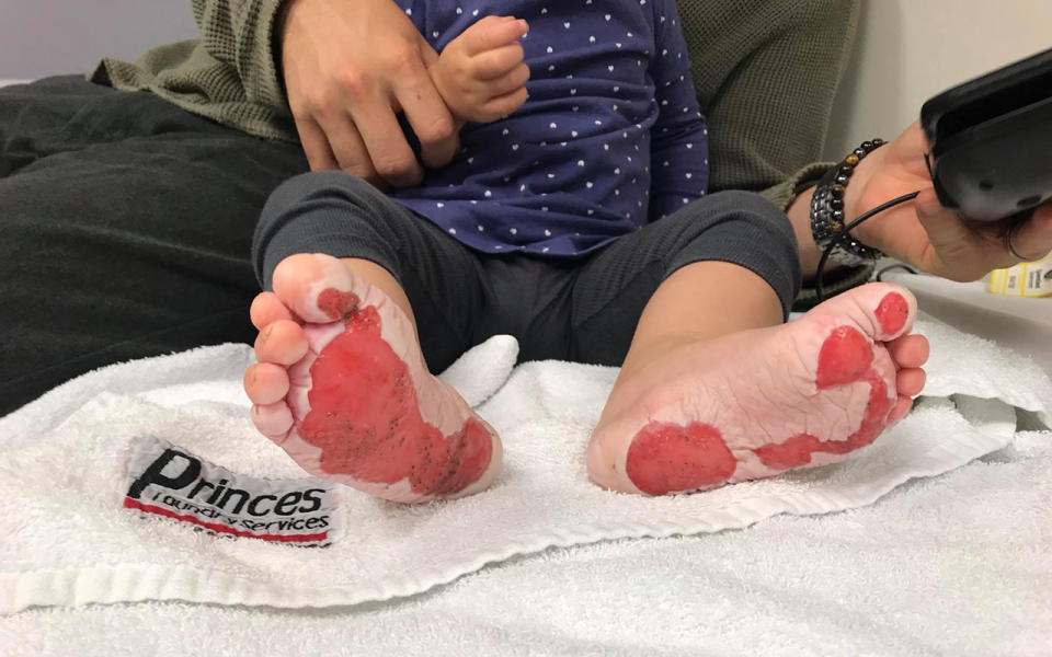 The 18-month-old suffered second degree burns to her feet. Image: Facebook/Simone Pickering