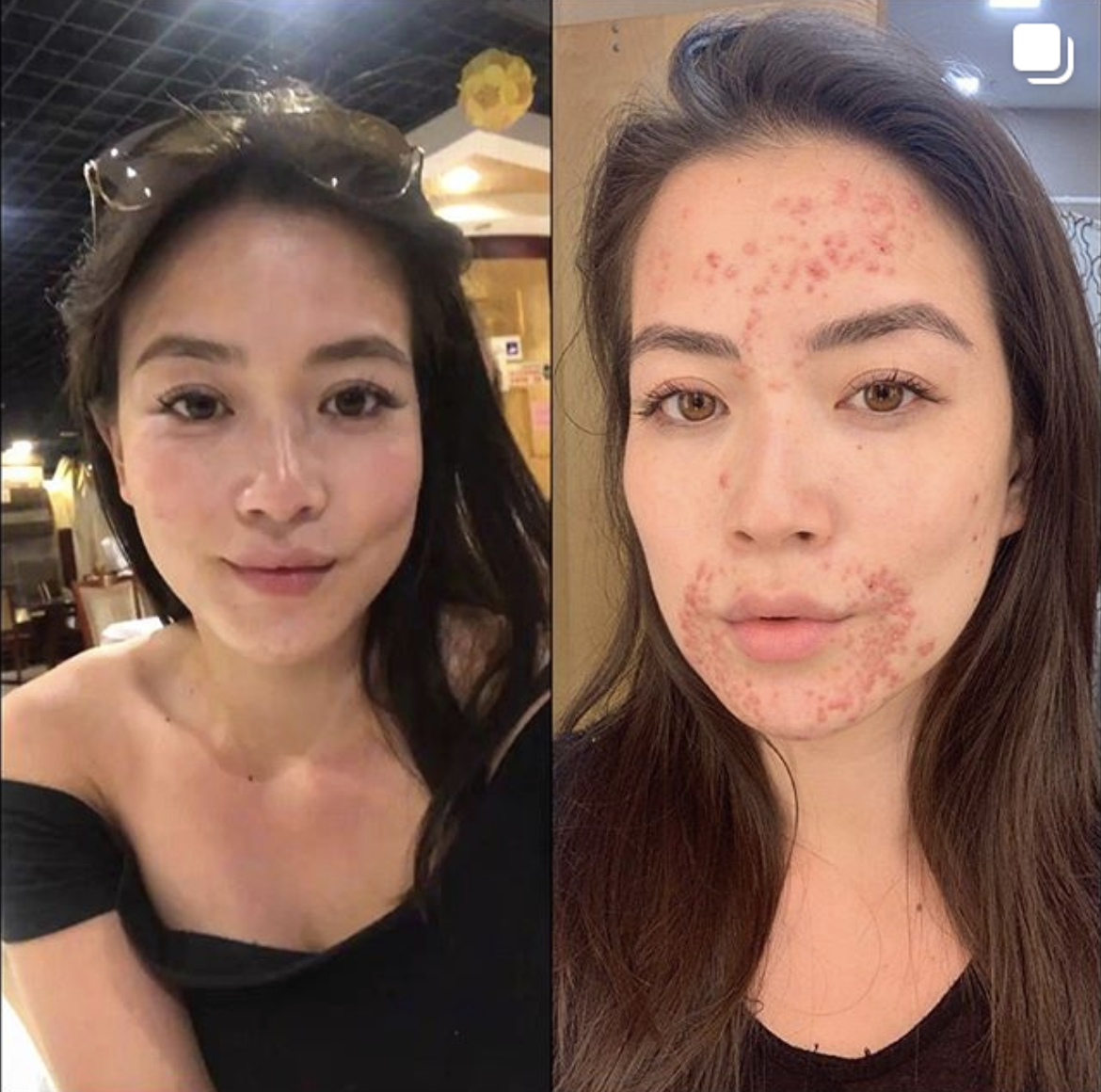 Frances Wang, a TV reporter and anchor for CBS Miami, is back on the air after dealing with a painful skin condition. (Photo: Instagram/franceswangtv)