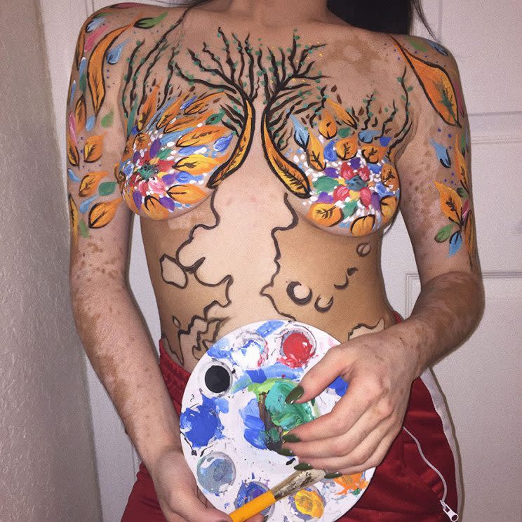 A woman with vitiligo shows off her naked torso, painted in a colorful floral theme to accentuate her skin color differences.
