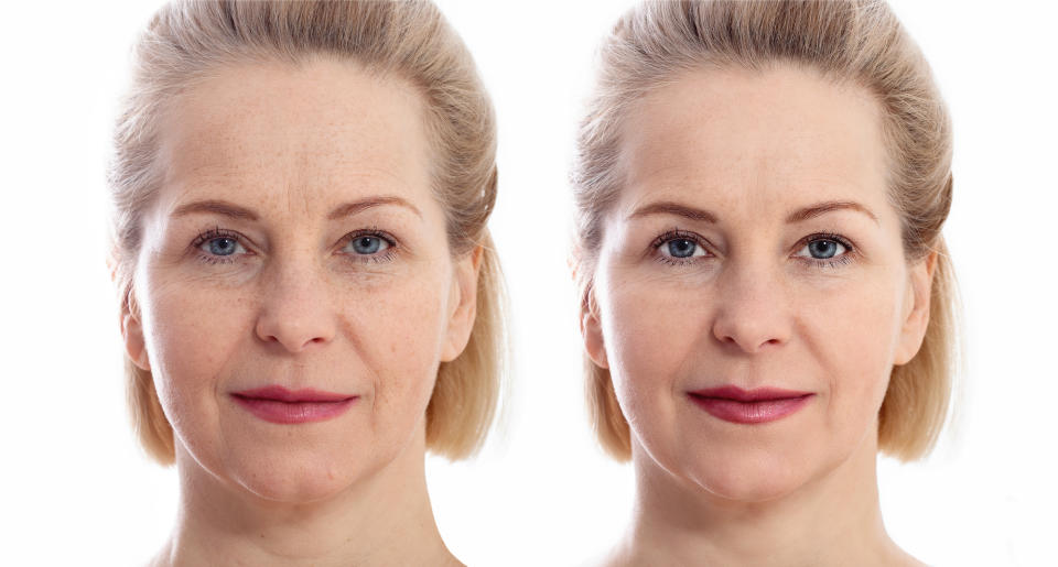 Before-After-Facelift-Stock-Photo