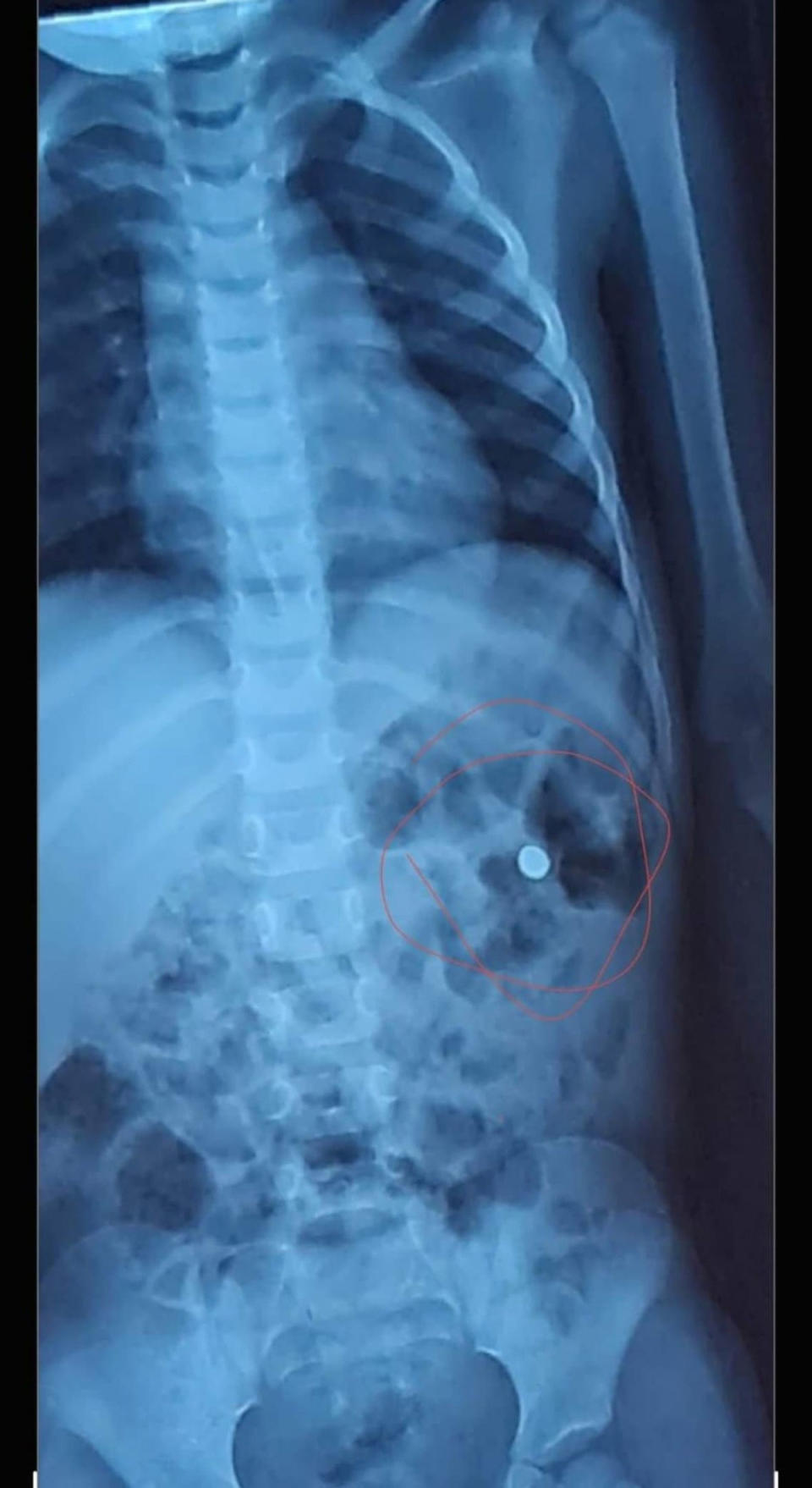 Pictured is the boy's x-ray which shows the battery inside.