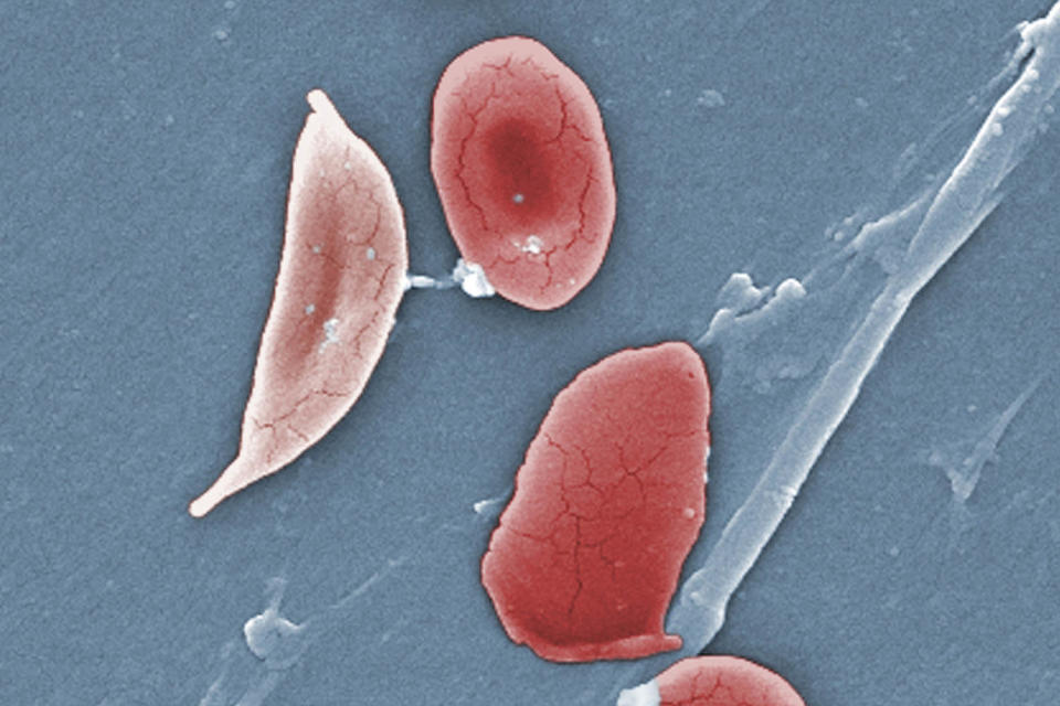 A microscope image of sickle cell and red blood cells. (Janice Haney Carr / CDC / Sickle Cell Foundation of Georgia via AP file)