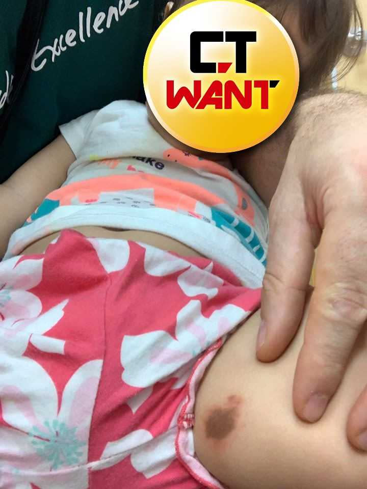 小女兒被怪蟲咬皮膚變色。（圖／翻攝自臉書）