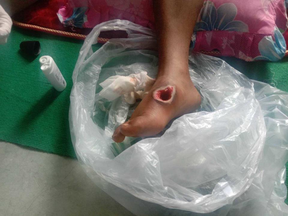 This May 14, 2021 photo obtained by The Associated Press shows a patient's foot which was injured by a landmine in Myanmar's Kachin state. The patient's foot had to be amputated by doctors working at an underground clinic. (AP Photo)