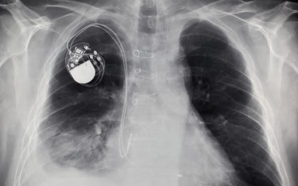Pacemakers save lives but they are bulky and need replacing every few years 
