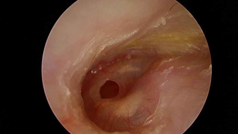 婦人耳膜破損範圍占耳膜的15%，且經常出現分泌物、疼痛。（圖／慈濟醫院提供）