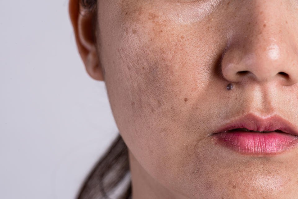 Woman with problematic skin and acne scars. Problem skincare and health concept. Wrinkles melasma Dark spots freckles dry skin and pigmentation on face asian woman.