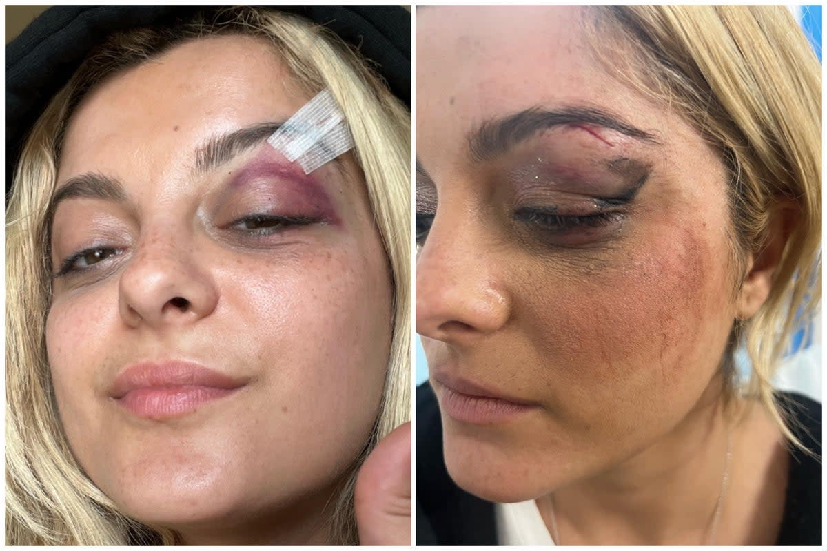 Bebe Rexha has shown off her painful looking injuries after having a phone thrown at her at a concert  (Instagram/Bebe Rexha)