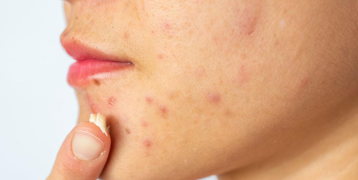 woman applying acne cream on her face for solving acne inflammation papule and pustule on her face