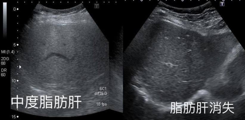 婦人在1年之內解決中度脂肪肝問題，連醫師都感到驚訝。（翻攝臉書粉專「錢政弘 胃腸肝膽科醫師」）