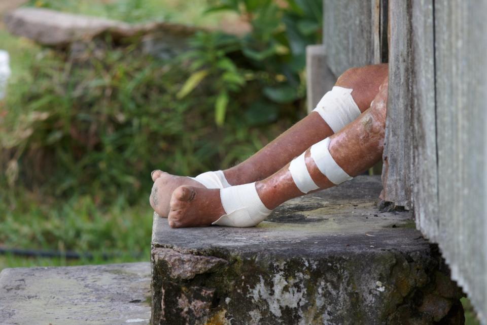 Bandaged feet and legs of a person with leprosy.