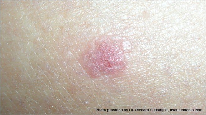 skin cancer pictures: photo of a Squamous cell carcinomas