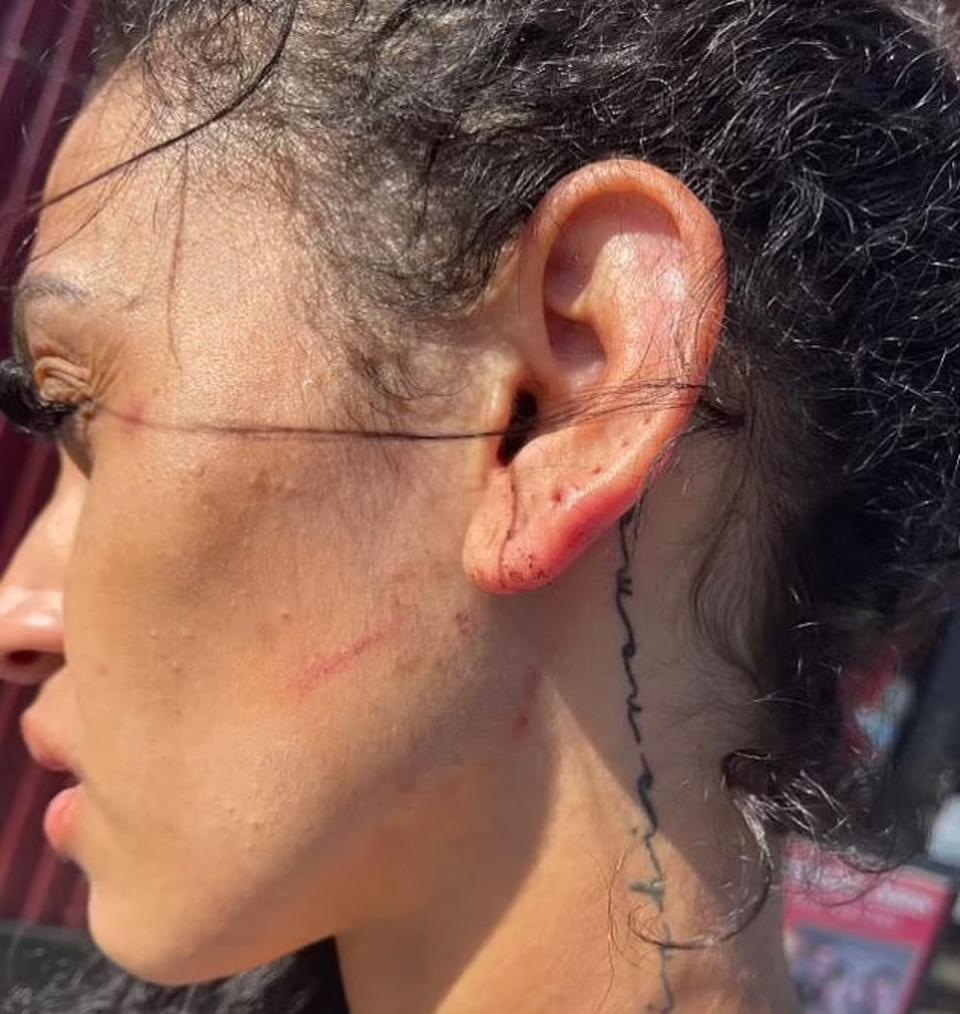 Mychelle Johnson posted images of her injuries on social media (Mychelle Johnson / Instagram)