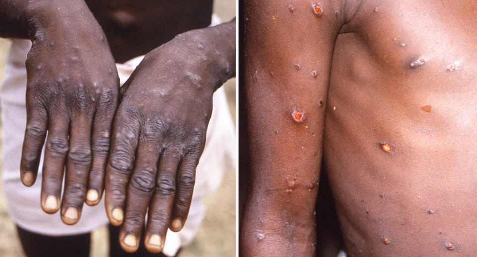 Monkeypox rashes on hands (left) and a torso (right)