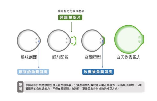 角膜塑型片是一種夜間配戴的隱形眼鏡，主要目的為「控制近視」，也就是減緩孩童的近視度數上升。｜圖片來源：EyePlus 光與自然親子眼科